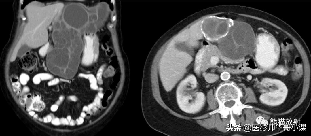 「精品课件」11种腹膜感染/炎症性病变的影像学表现
