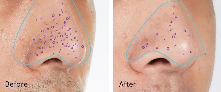 有黑头和没黑头有什么区别,没有长过黑头却长黑头怎么办