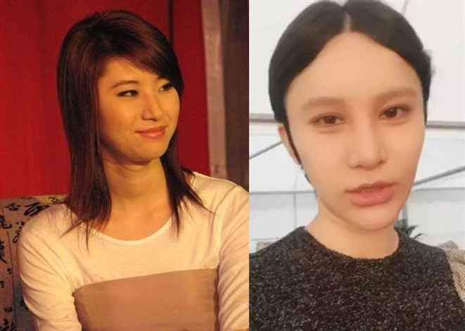 法令纹填充玻尿酸显老,玻尿酸填充法令纹显老怎么办