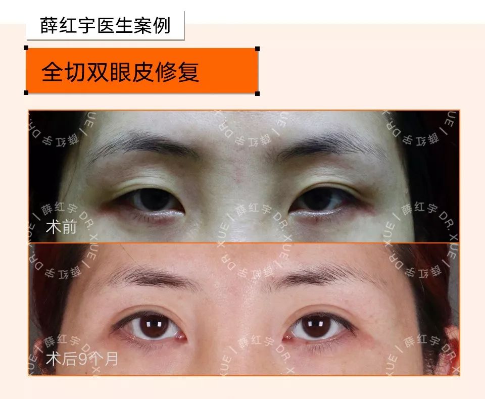 双眼皮整形修复,潘贰双眼皮修复