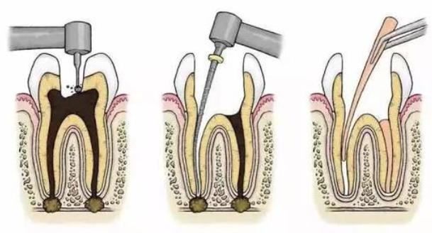 被牙痛折磨的痛苦你真的无法体会,牙医都不会告诉你的牙疼方法