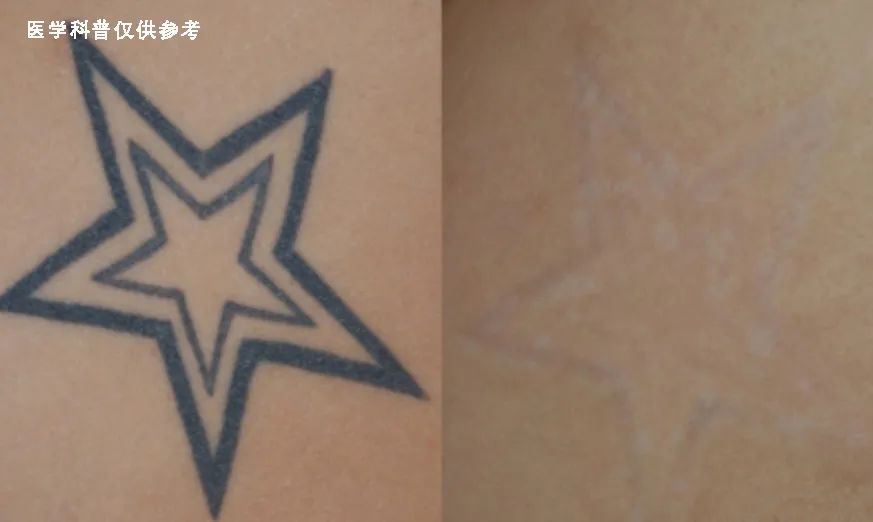 激光祛纹身的正确方法,激光快速祛纹身方法