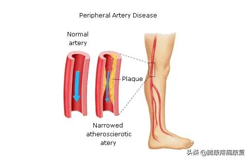 小腿疼痛的原因和治疗原则图片,脚小腿肌肉疼痛是什么原因