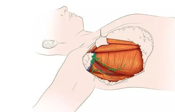 肺癌术后排痰最佳方法,肺癌早期住院流程详细