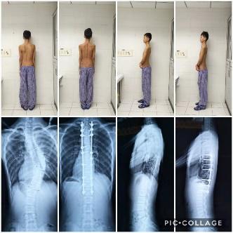 北京青少年脊柱侧弯矫正最佳方法,北京脊柱侧弯校正