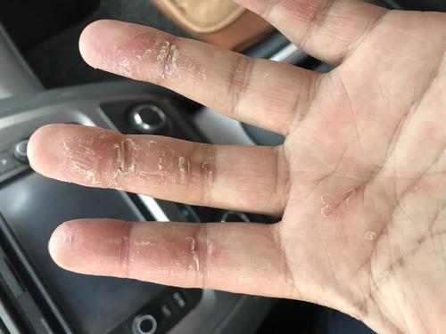 手秋冬脱皮脱得很严重怎么办,一到秋天手就脱皮怎么办