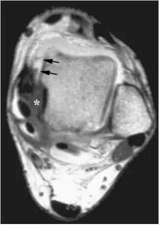 踝关节撞击症问诊,踝关节撞击综合征的x线表现