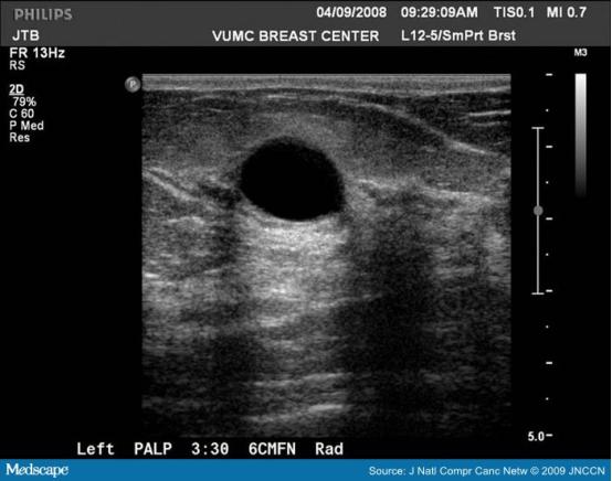 乳腺结节bi-rads分级依据,国内乳腺结节bi-rads分级标准
