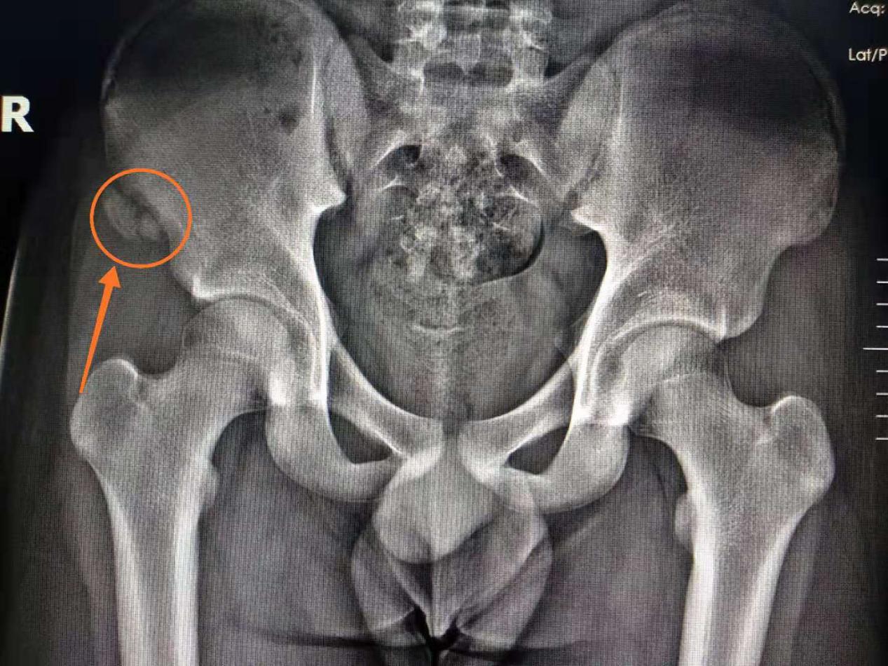 肌肉缺失容易骨折吗,肌肉累导致骨折