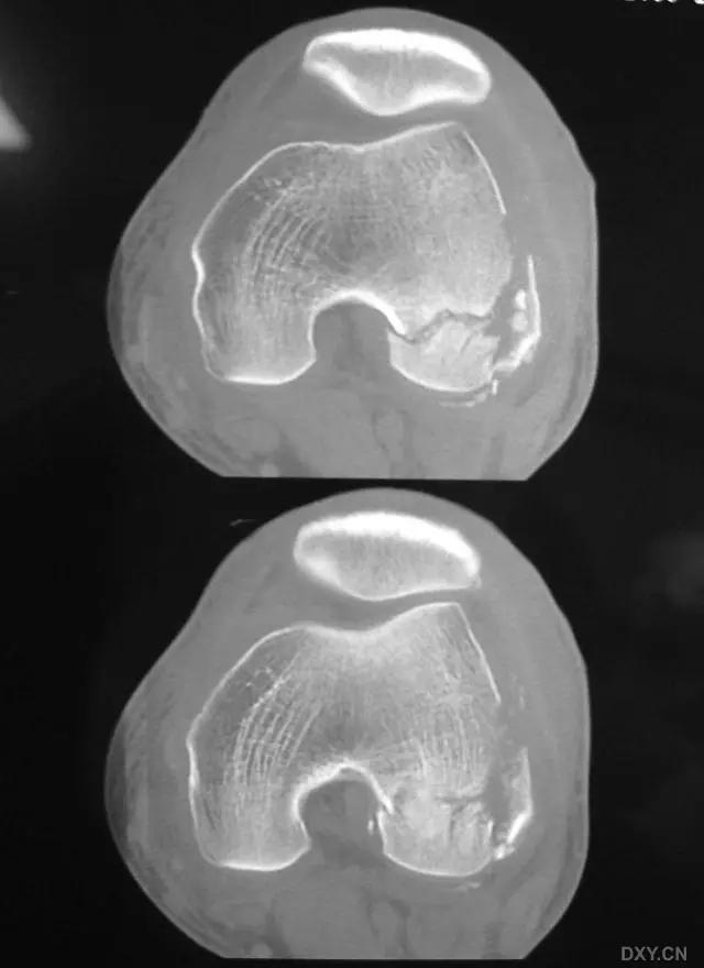 所有骨折都叫什么名字,骨折的名称有哪些