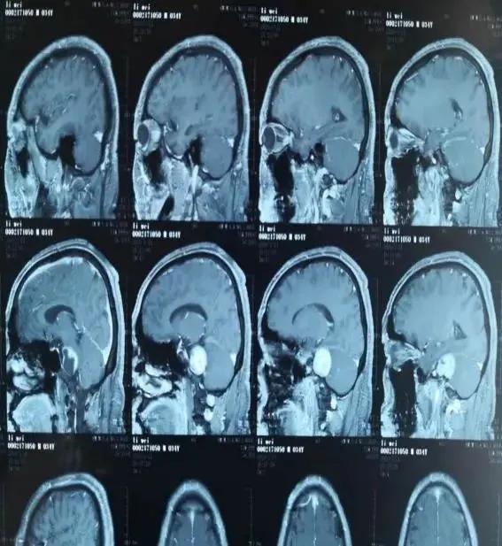 30岁男子右耳堵塞听力下降,46岁男性突然一只耳朵听力下降