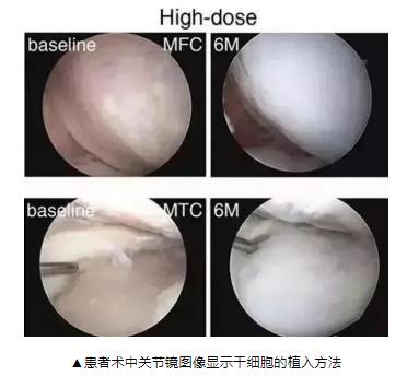 半月板损伤干细胞,半月板损伤干细胞注射液价格