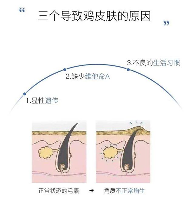 果酸精华改善鸡皮肤,医院果酸换肤鸡皮肤能用吗