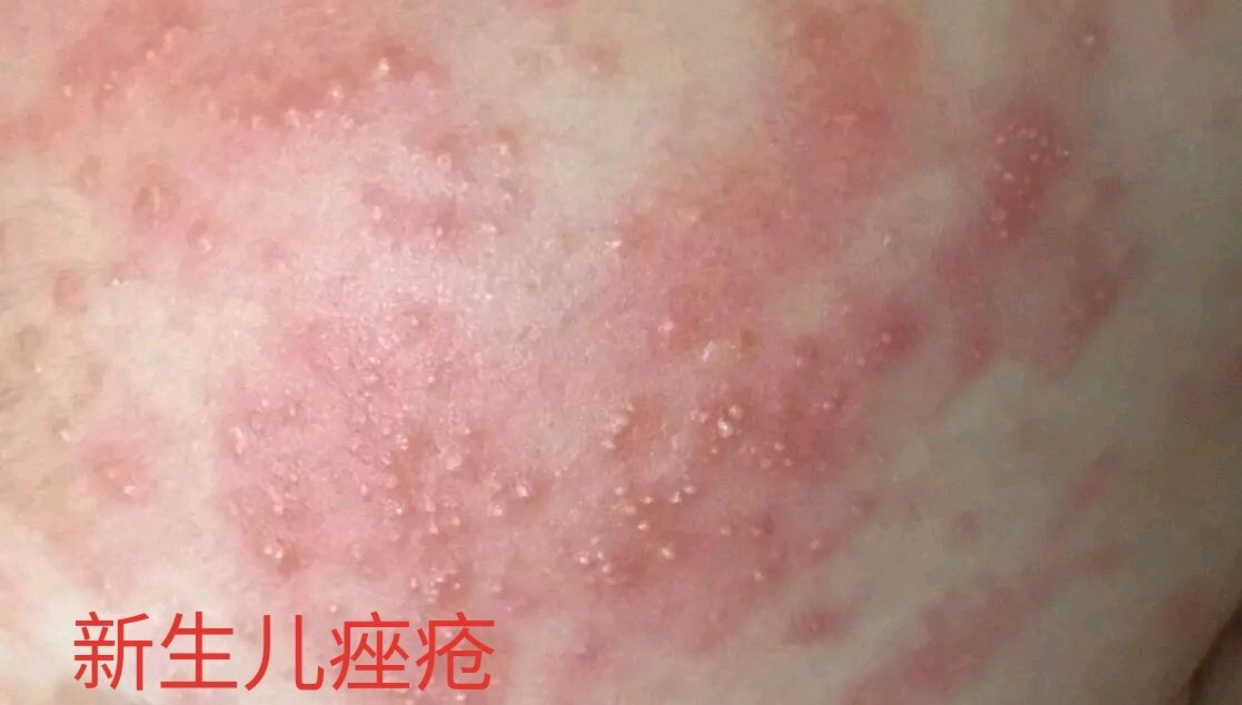 宝宝脂溢性湿疹可以涂什么药膏,宝宝湿疹脂溢性皮炎