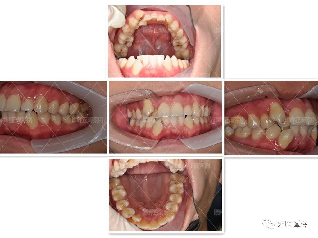 牙齿不齐牙列拥挤怎么矫正,牙列不齐拥挤矫正大约要多少钱