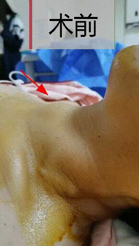 哈尔滨微创消融甲状腺结节哪家好,甲状腺结节微创消融术的过程