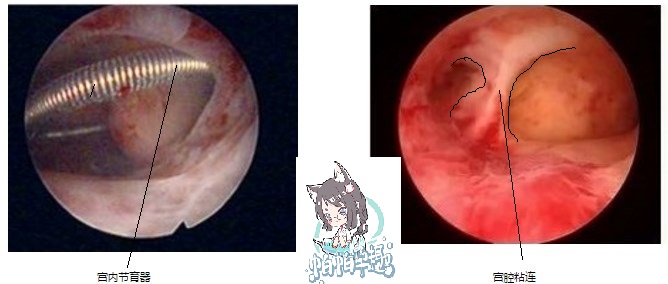 宫腔镜片子一般有几个图像,不学医的话懂看诊流程吗