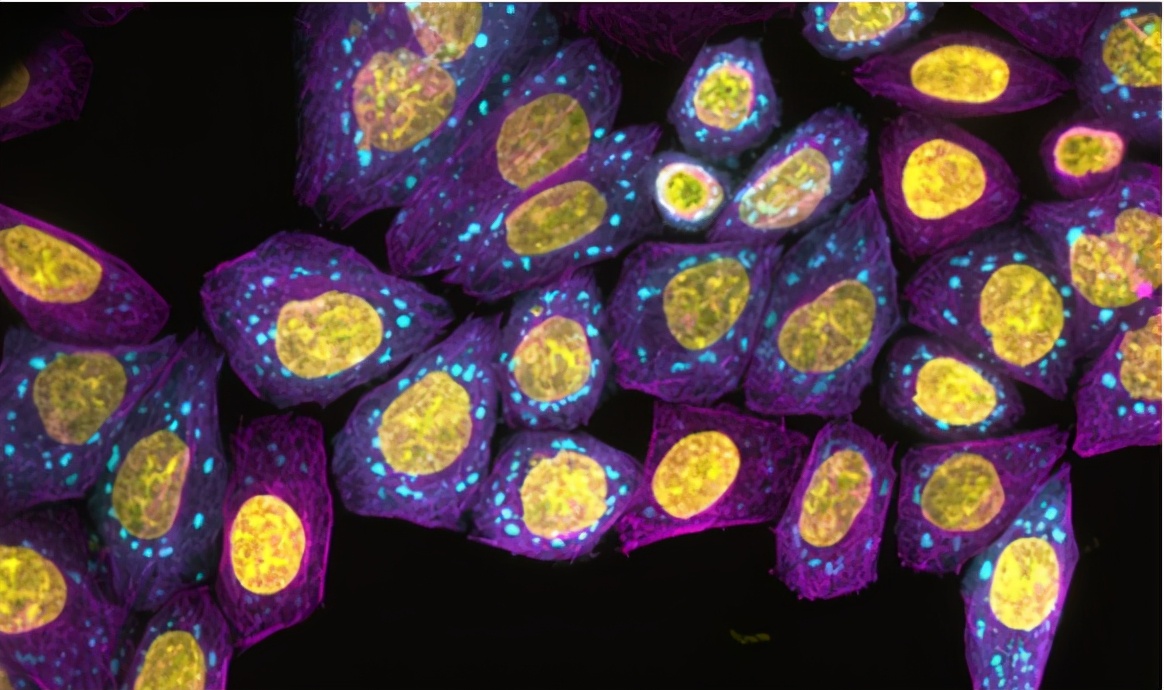 人工智能攻克精神疾病,人工智能筛查阿尔茨海默症