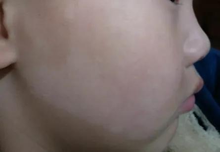 白斑和白癜风的鉴别方法,白癜风和日光性白斑鉴别诊断