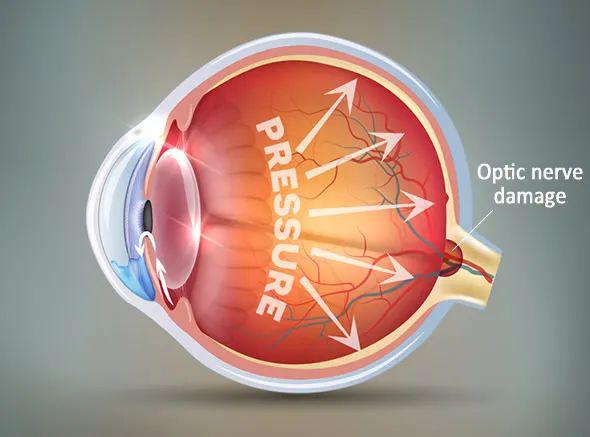 青光眼预防,认识青光眼