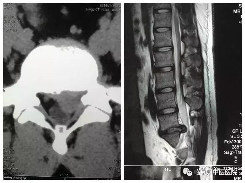 临夏州腰椎间盘突出微创手术,甘肃省中医院脊柱科微创手术