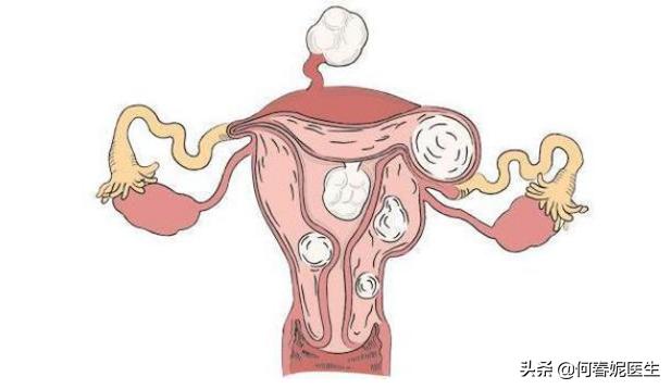 子宫肌瘤排除恶变方法,发现子宫肌瘤需要怎么办