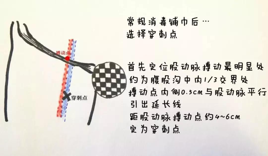 股静脉穿刺置管输液,股静脉穿刺置管术详细讲解