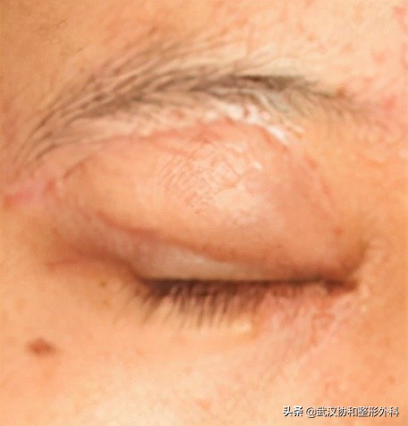 长了很多黑痣是什么原因,不规则的黑痣一定会癌变么