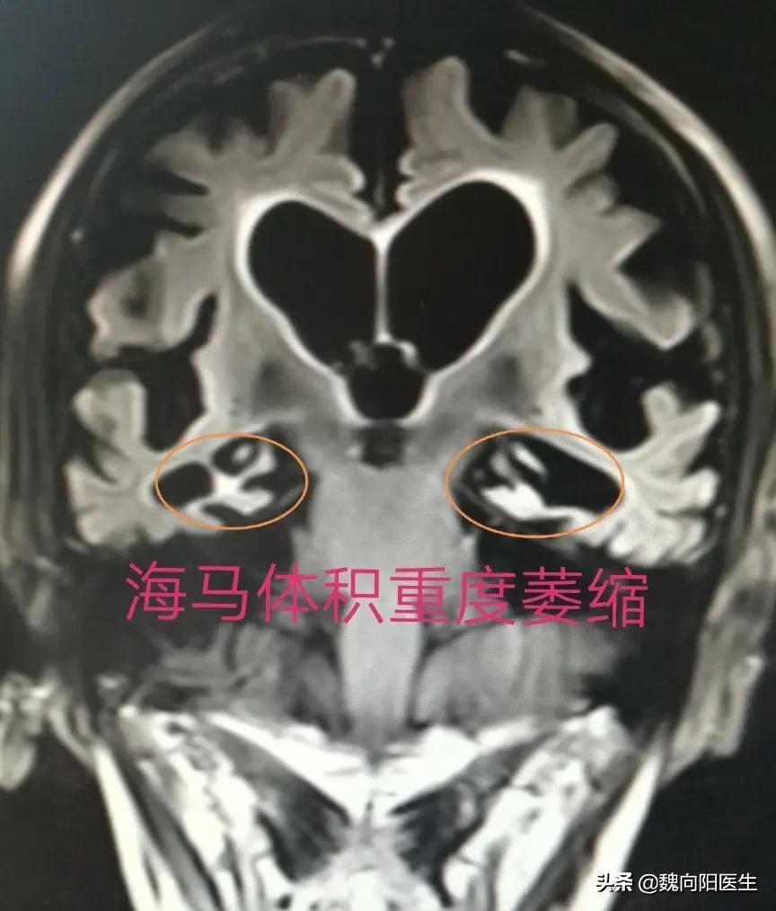 按摩大脚趾可以预防老年痴呆视频,10个简单的手指动作预防老年痴呆