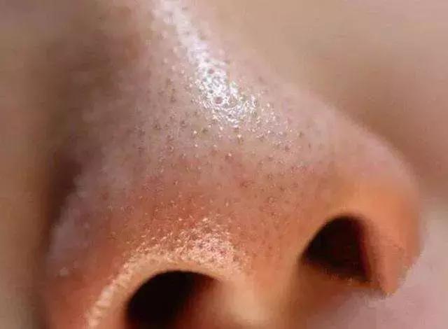 头皮油头皮痒头皮屑多,头皮油头皮屑多头发干枯