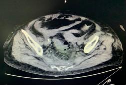 肠穿孔非手术治疗措施,结肠穿孔治疗视频