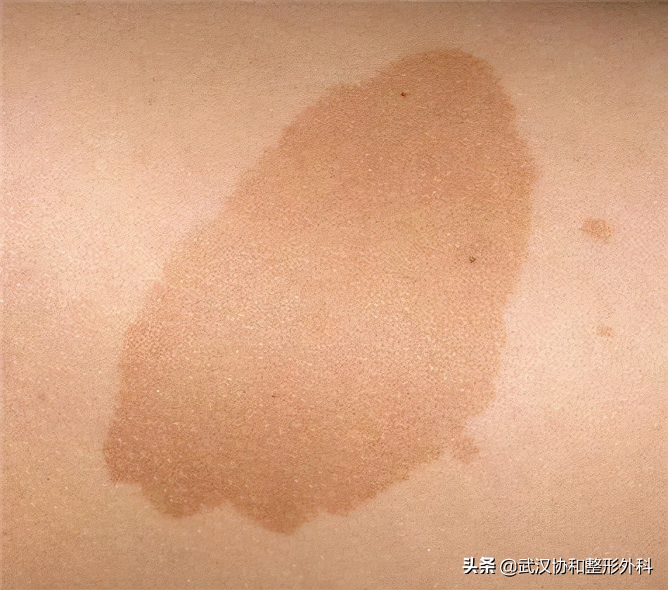 咖啡牛奶斑一定是神经纤维瘤吗,咖啡牛奶斑会突然出现吗