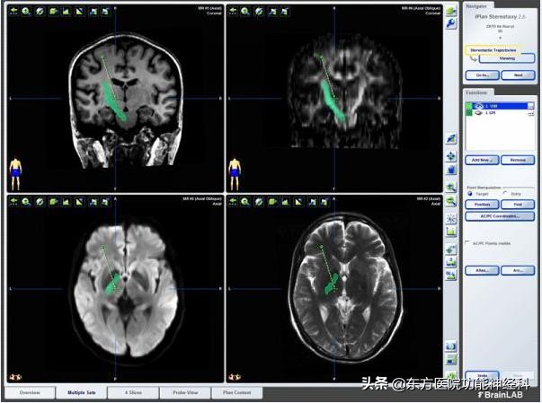 抽动秽语综合征的药物治疗,抽动秽语综合症哈尔滨治疗