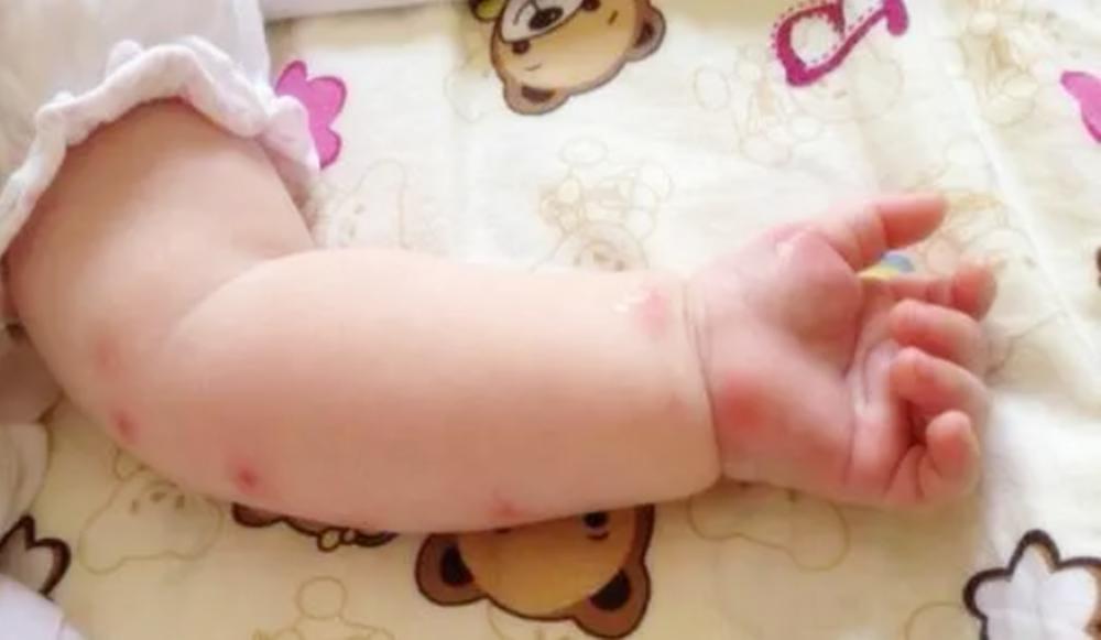 宝宝老是被蚊子咬有什么驱蚊方法,宝宝被蚊子叮了红点越来越大