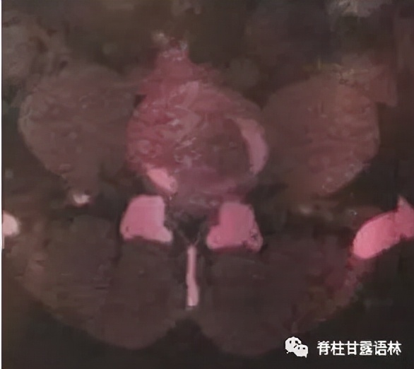 腰椎间盘突出中央型和旁侧型,腰椎间盘与椎板间隙的对应关系