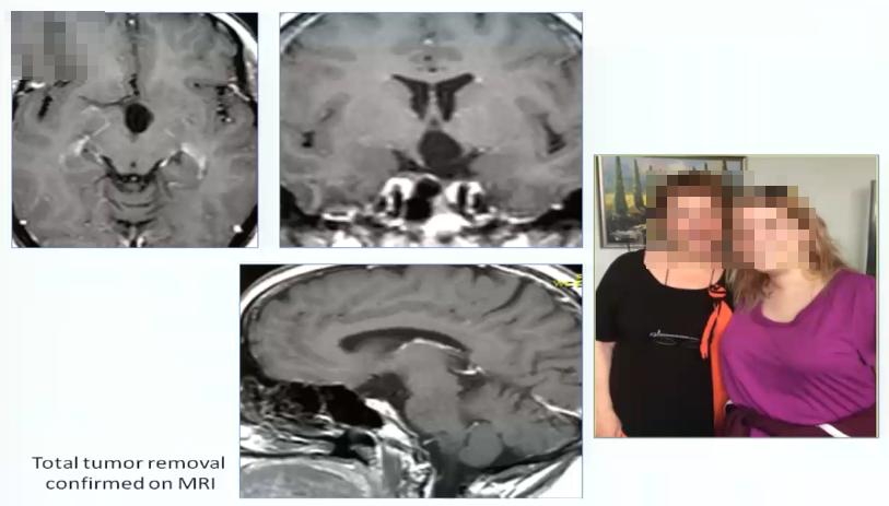 INC巴特朗菲教授视频|视神经-下丘脑胶质瘤全切案例集及治疗解读