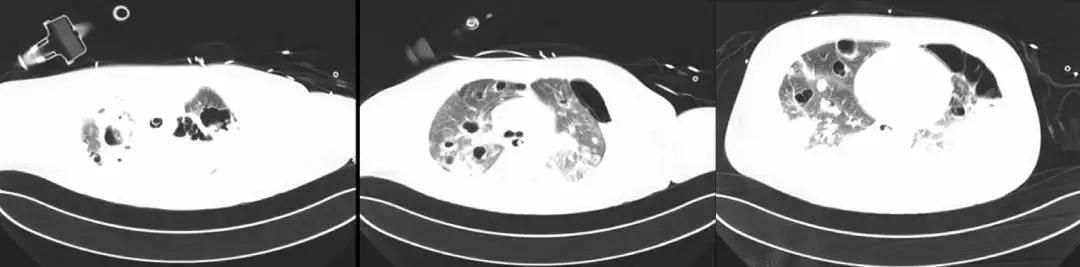 万古霉素用于mrsa的作用机制,万古霉素无效还有什么抗生素可用