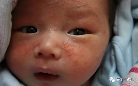宝宝出现湿疹的原因和护理措施,高烧湿疹的症状及治疗方法