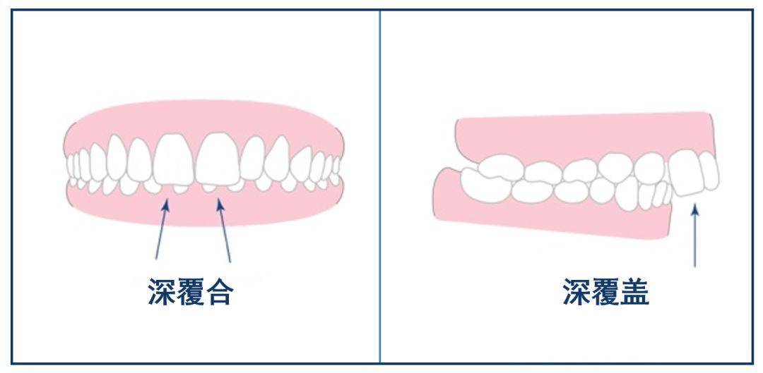 深覆盖vs深覆合,深覆盖和深覆合哪个难度大