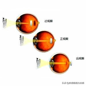 眼睛近视150到200度需要配眼镜吗,12岁眼睛近视150度需要配眼镜吗