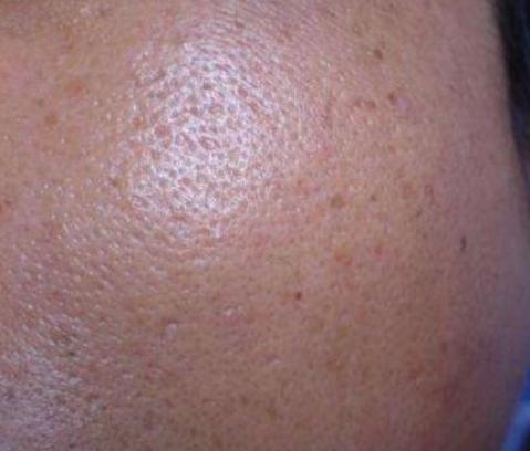 打败毛孔!下一个反孔精英就是你!