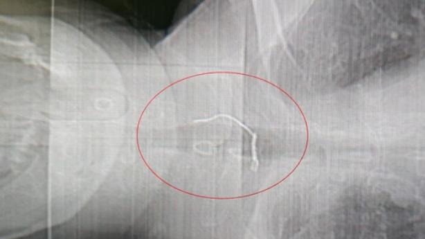 误食异物卡在喉咙真实案件,男子误吞6公分鱼刺肠道被戳