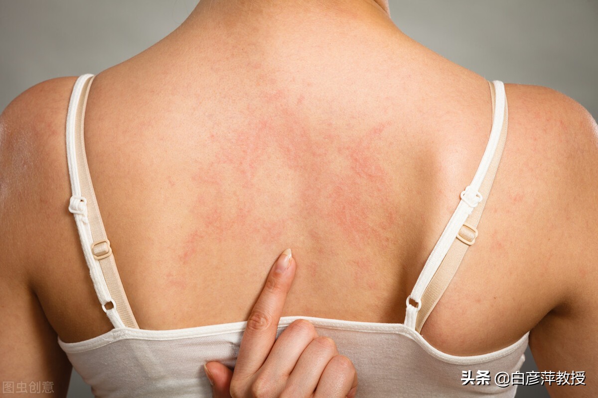 *麻疹荨**是啥病？哪些人容易患*麻疹荨**？这里给您解答