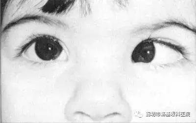 如何分辨斜视的眼睛,怎么分辨眼睛有没有斜视