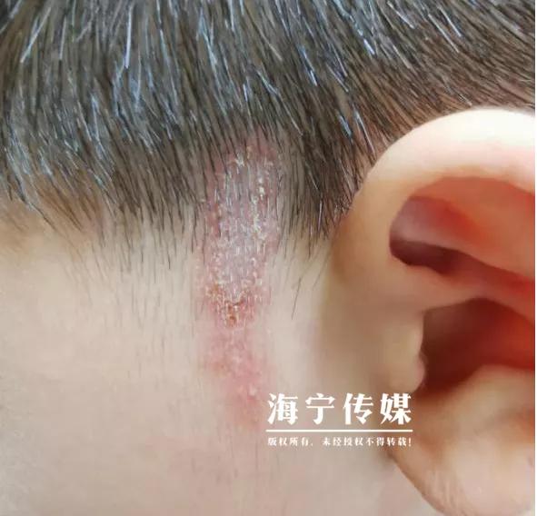 3岁男孩皮肤溃烂怎么办,六岁孩子脸碰破皮抹什么