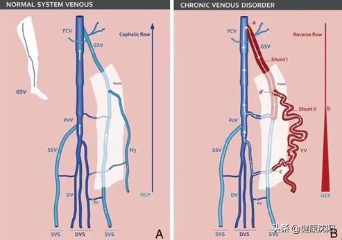 山东开展chiva治疗静脉曲张,chiva是微创治疗静脉曲张吗