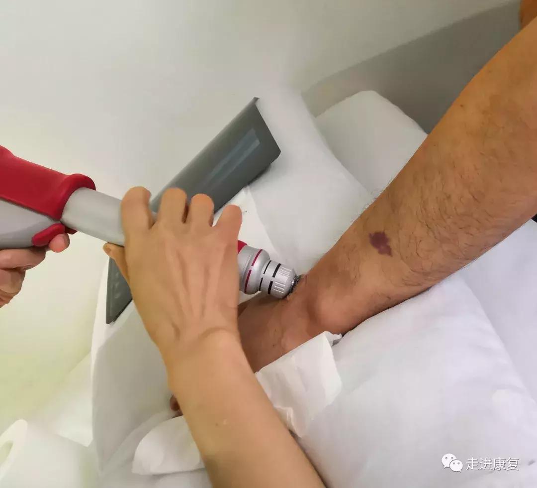 多学科合作精准定位下冲击波联合PRP治疗骨折延迟愈合/骨不连