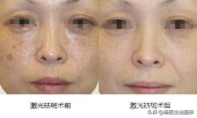 遗传雀斑激光祛斑最真实的经历,遗传性雀斑用激光祛斑的费用