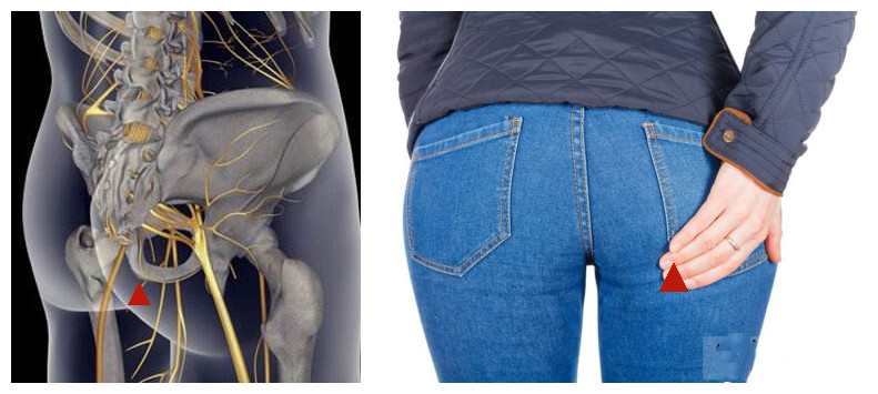 臀部感觉有根筋痛,臀部有一个点酸疼怎么回事