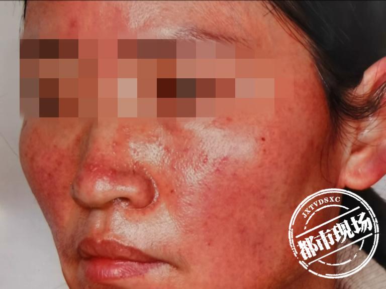 女子花2万元祛斑致毁容,江西鹰潭克丽缇娜